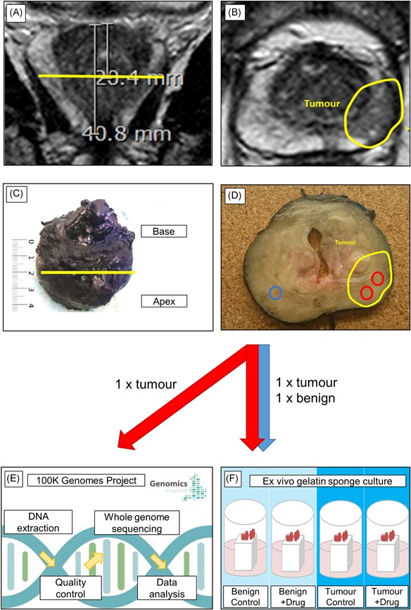 PEOPLE: PatiEnt prOstate samPLes for rEsearch, a tissue collection pathway utilizing magnetic resonance imaging data to target tumor and benign tissue in fresh radical prostatectomy specimens.